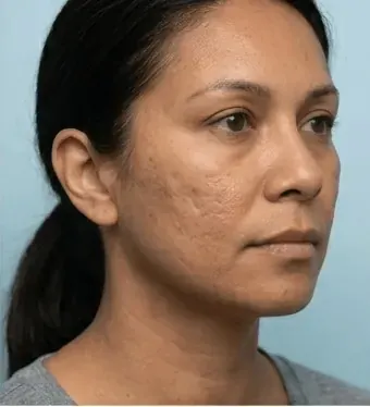 Before — Procell microchanneling — texture and laxity improvement